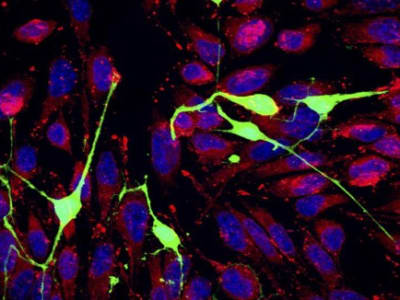 Sel Kanker Mencuri Energi dari Neuron untuk Bertahan dan Menyebar