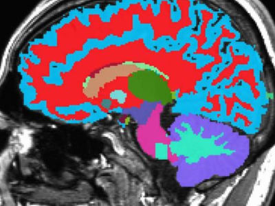 Alat Baru Prediksi Penuaan Otak dengan Satu Pemindaian MRI