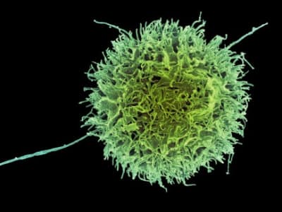 Terapi Sel Natural Killer Rekayasa Genetik: Terobosan Murah Atasi Penyakit Autoimun