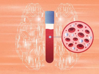 Metode AI 'Fragle' Mempermudah dan Mempercepat Pemantauan Kanker Lewat Darah