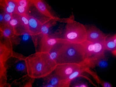 Kemoterapi Dapat Membangunkan Sel Kanker Dorman dan Sebabkan Penyebaran Kanker