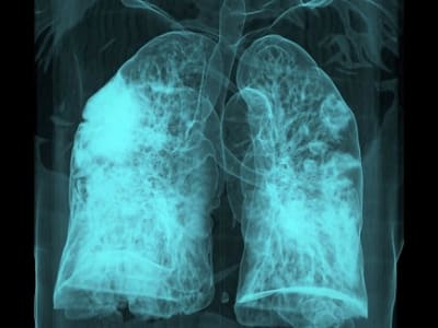 Infeksi COVID-19 Bisa Bangkitkan Sel Kanker Dormant dan Tingkatkan Risiko Kematian