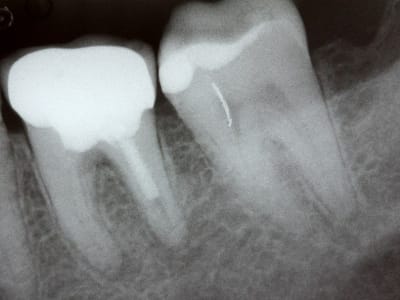 Bakteri Gusi Porphyromonas gingivalis Bisa Sebabkan Gangguan Irama Jantung AFib