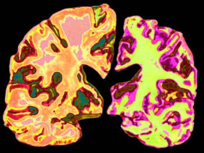 Pengisian Lithium Alami di Otak Bisa Membalikkan Alzheimer Secara Revolusioner