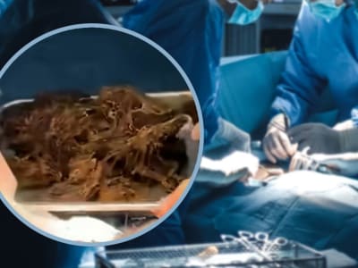 Remaja di Cina Alami Pembesaran Perut Akibat Menelan Rambut Sendiri