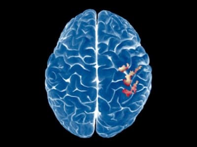 Penelitian Baru: Peta Otak Tidak Berubah Setelah Amputasi Lengan