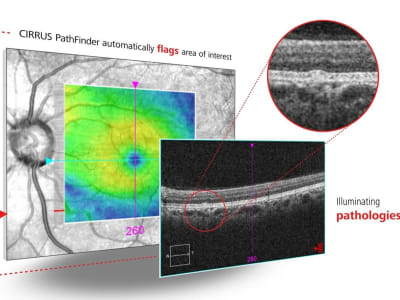 Zeiss CIRRUS PathFinder: Alat AI Canggih untuk Bantu Diagnosis Penyakit Mata dengan Cepat