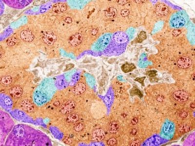 Terobosan Terapi Diabetes: Sel Edit Gen CRISPR Produksi Insulin Tanpa Obat Imun