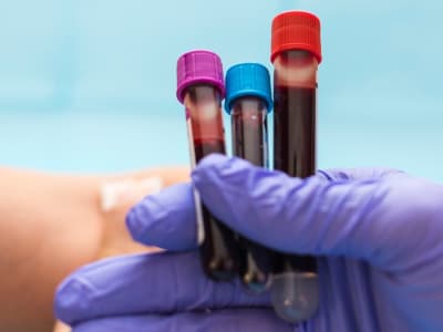 Tes Darah Baru dengan Akurasi 96% untuk Diagnosis Sindrom Kelelahan Kronis