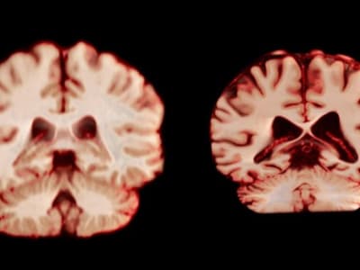 Menurunnya Volume Otak Pria Lebih Cepat, Kenapa Wanita Lebih Sering Alzheimer?