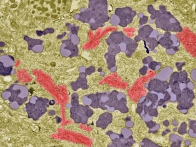 Tes Darah Baru Dapat Menyingkirkan Alzheimer dengan Akurasi Tinggi di Klinik