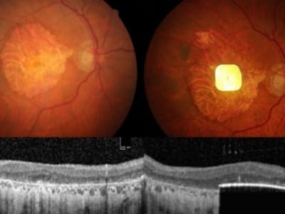 Implan Retina Mini Mengembalikan Penglihatan untuk Penderita Degenerasi Makula