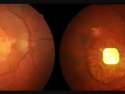 Implan Mata PRIMA Kembalikan Kemampuan Membaca pada Penderita Kebutaan