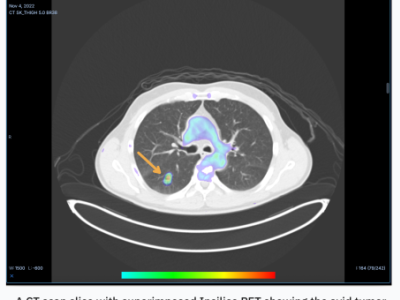 AI RADiCAIT Ubah CT Menjadi PET, Permudah Diagnosa Kanker Hidupkan Harapan Baru