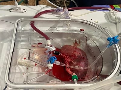 Ilmuwan Spanyol Ciptakan Ginjal Hibrida Manusia-Babi yang Berfungsi