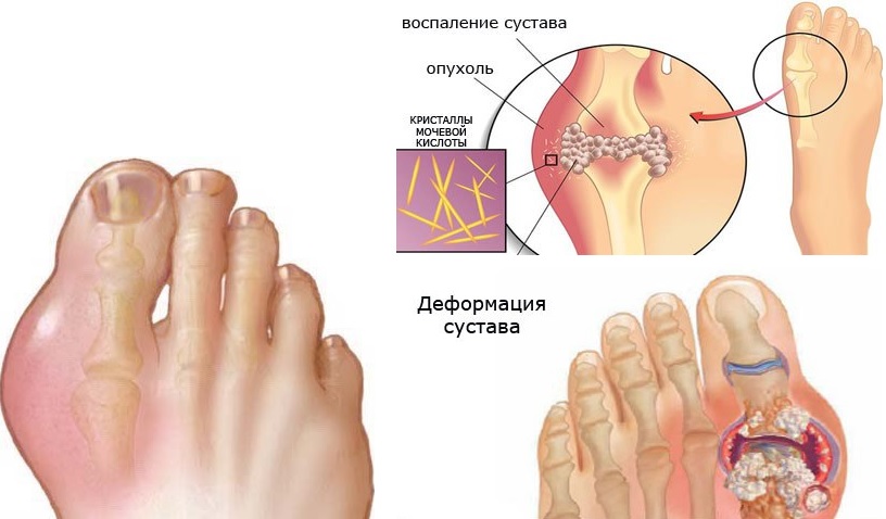 Подагра определяется