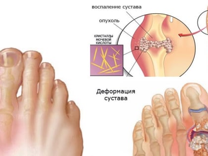Подагра - что это такое ?