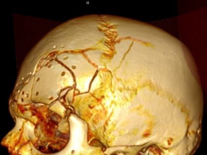 Врачи Липецкой областной клинической больницы вернули лицо  пострадавшему в аварии мотоциклисту