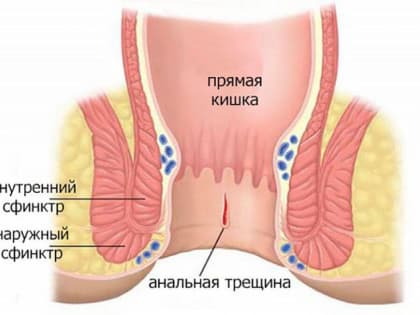 Анальная трещина