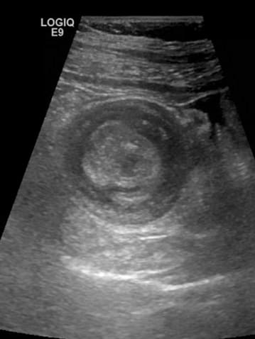 ultrassonografia mostrando imagem em alvo