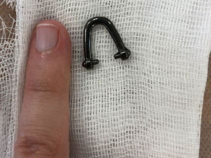 В Новороссийске из пищевода малыша «крысиным зубом» достали «подковку»