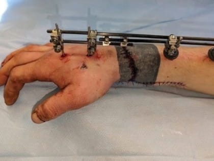 Кубанские врачи пришили молодому человеку отрубленную руку