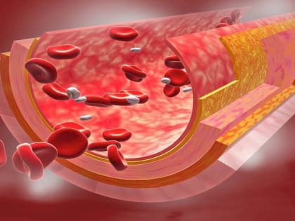 Как почистить сосуды в домашних условиях: вот для чего вашему организму нужен эндотелий, и как его восстановить