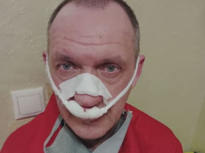 В Краснодаре мужчина сломал нос доктору, который вытащил его с того света