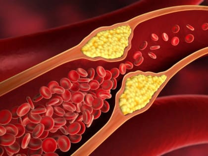 Высокий уровень холестерина: признаки накопления жира на стенках артерий
