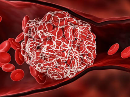 Врач рассказала, как предотвратить появление тромбов