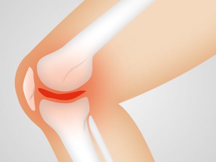 Больше не болит: как лечить боль в колене естественным путем