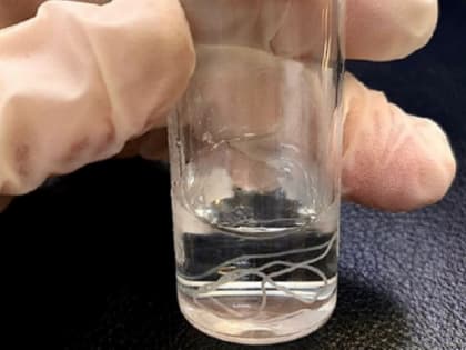 "Подселенца" в виде червя-паразита достали из тела жительницы Краснодара