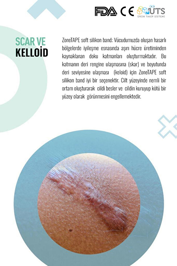 ZoneTAPE Soft Silikon Bant -kırışıklık-estetik-dikiş-skar-keloid-sezaryen-karın/kol/bacak Germe-ben Aldırma 5
