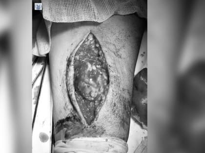 Оренбургские хирурги удалили пациенту большую аневризму в руке