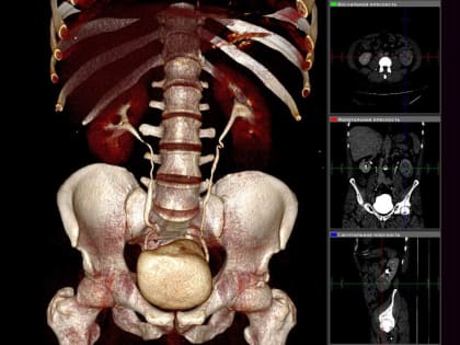 В онкодиспансере моделируют органосохранные операции