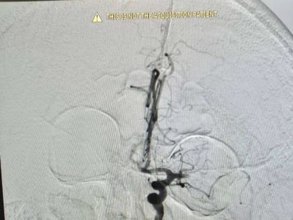 В Орске врачи спасти жизнь 74-летнему пенсионеру с ишемическим инсультом