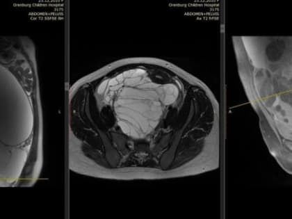Уникальная операция на яичнике в Оренбурге