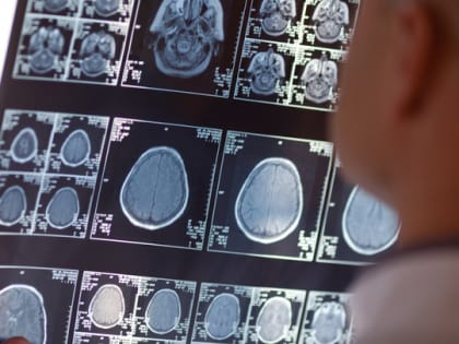 Неизвестное заболевание мозга обнаружили у троих детей