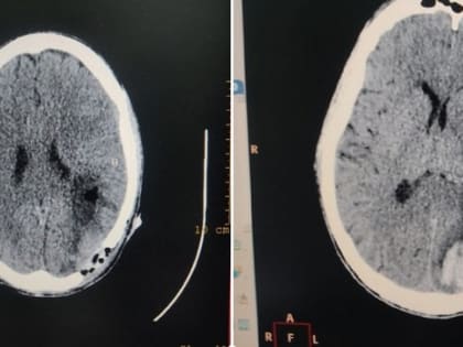 В Серпуховскую областную больницу доставили пациента с серьезной травмой мозга