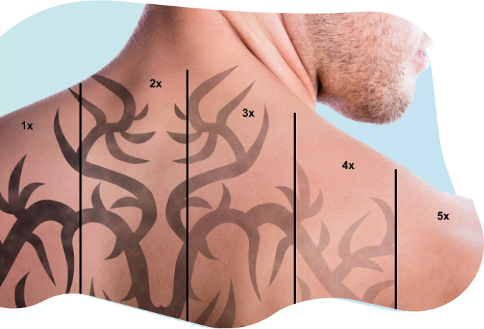 Man Tattoo Laser Removal, HD Png Download - Transparent PNG Free Download