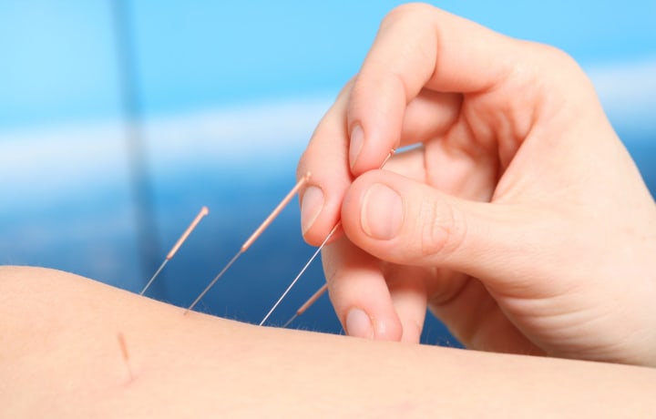 Trigger-point release using disposable, sterile needles.