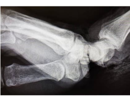 Медики ПИМУ спасли оторванную на производстве кисть руки женщины