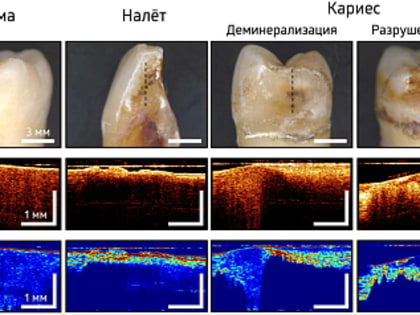 Метод диагностики раннего кариеса разработали в Нижнем Новгороде