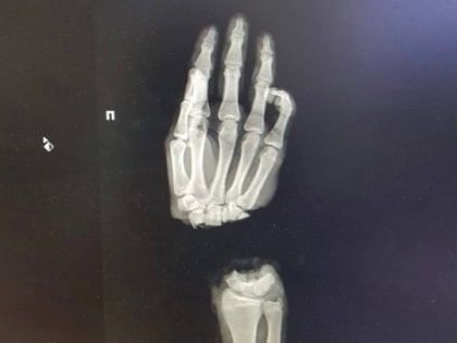 Врачи ПИМУ спасли отрубленную кисть руки 16-летнему подростку