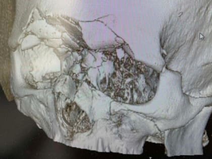 Нижегородцу раздробило кости лица строительным инструментом