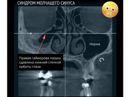 Женщину со съехавшим вниз глазом прооперировали в Нижнем Новгороде