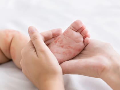 В Нижегородской области продолжается вакцинация от кори