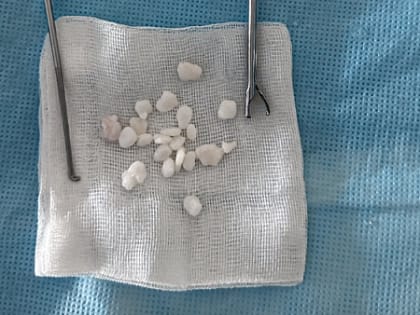 Нижегородский хирург извлек «суставных мышей» из колена пациента