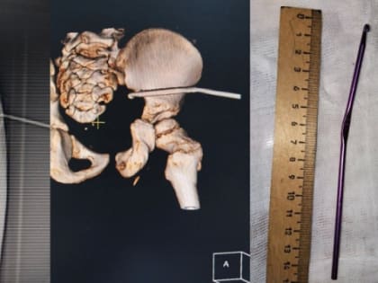 3-летний малыш проткнул ягодицу крючком в Нижнем Новгороде