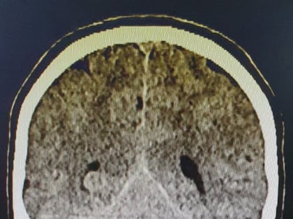 Нижегородские хирурги спасли 15-летнюю пациентку с инсультом